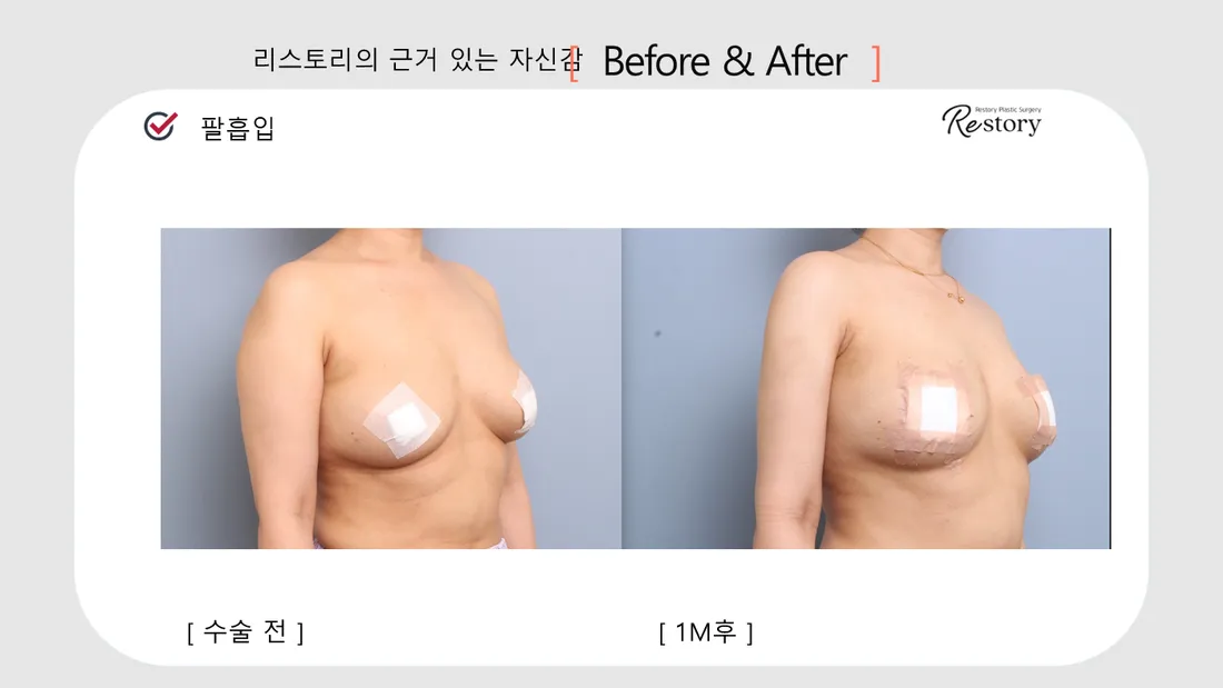 ボディ Before & After — リストーリー整形外科