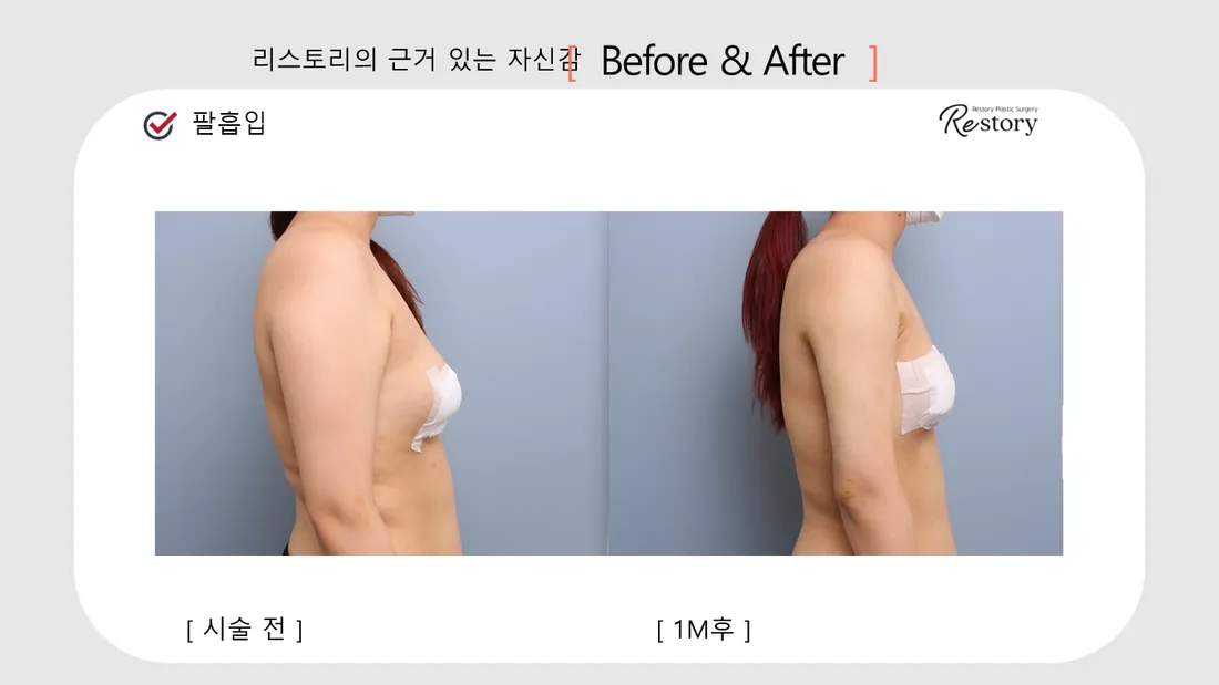 ボディ Before & After — リストーリー整形外科