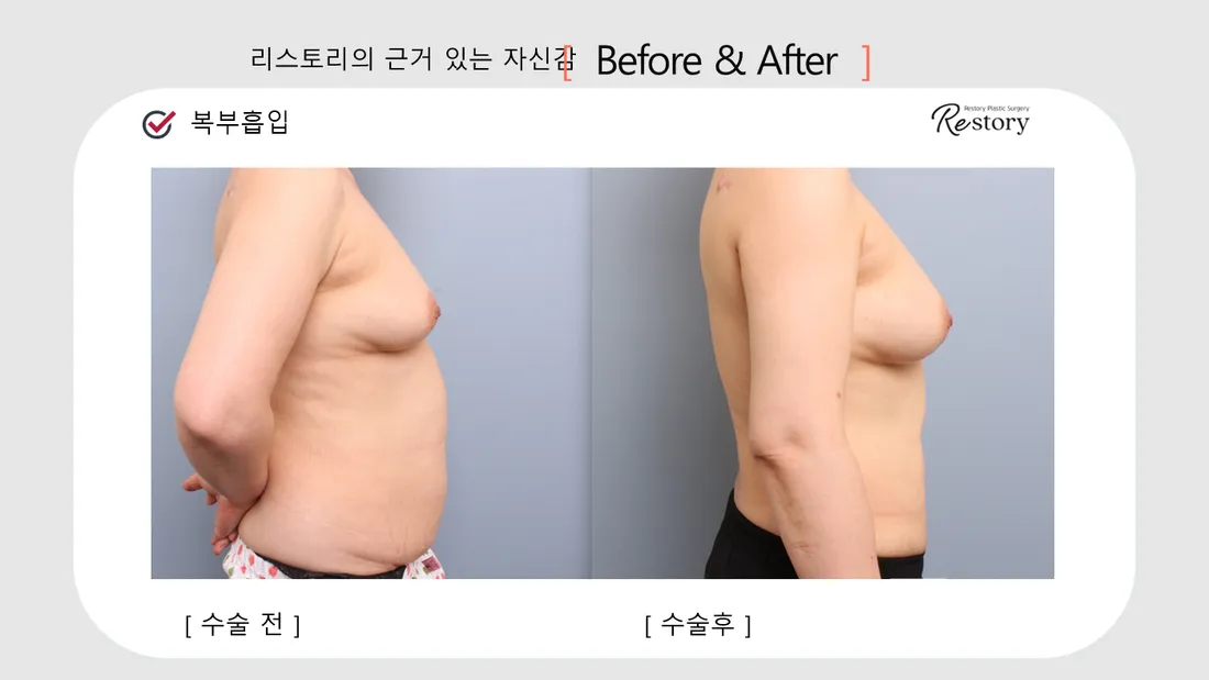 ボディ Before & After — リストーリー整形外科