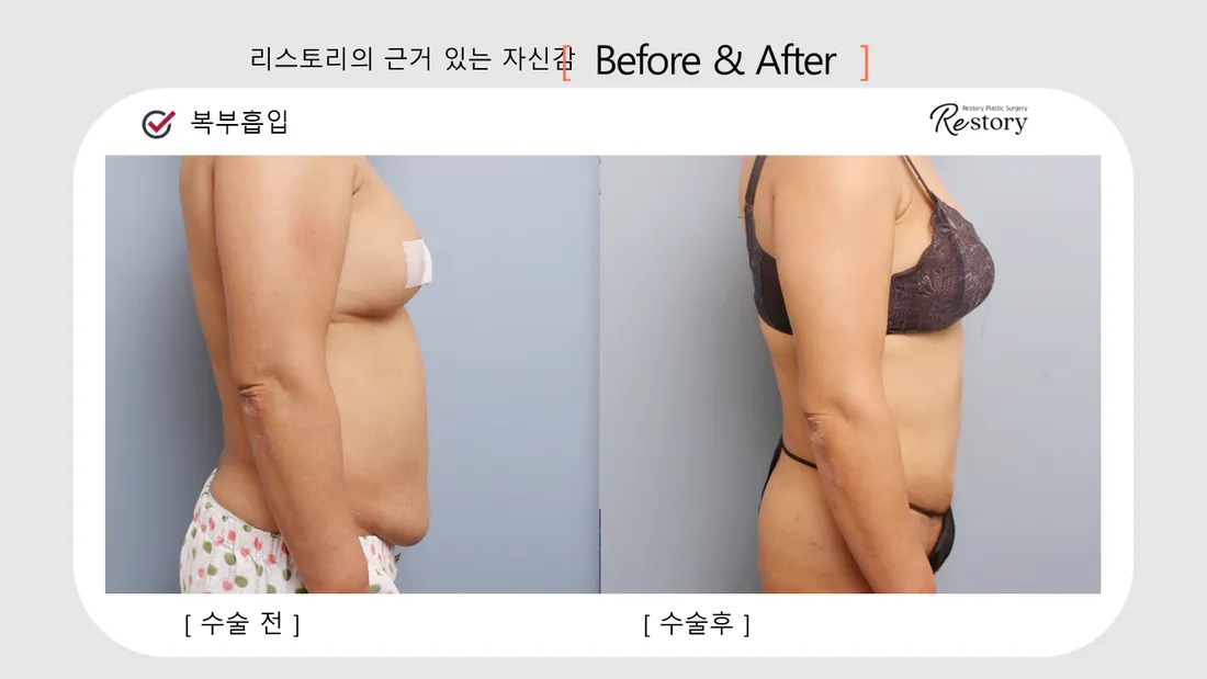 ボディ Before & After — リストーリー整形外科