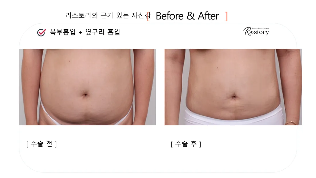 ボディ Before & After — リストーリー整形外科
