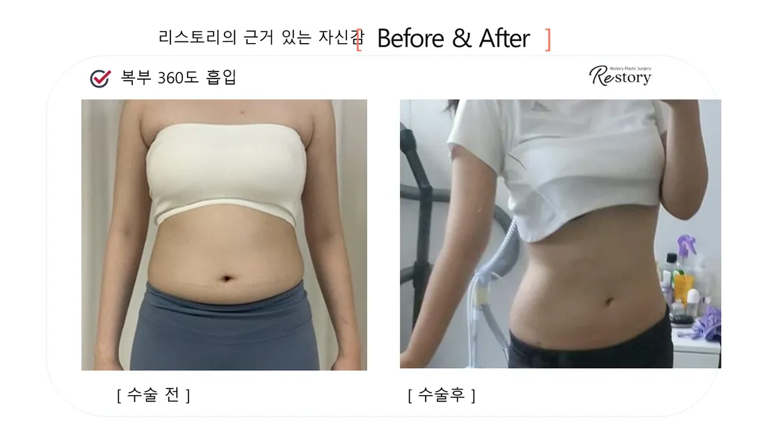ボディ Before & After — リストーリー整形外科