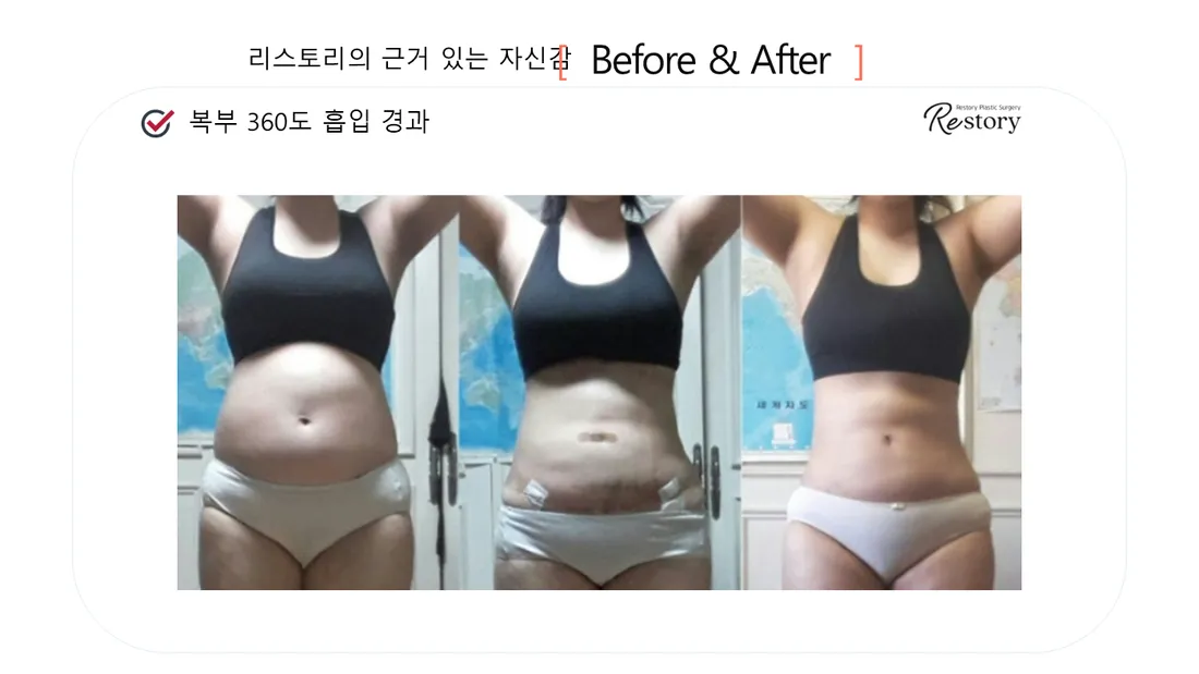 ボディ Before & After — リストーリー整形外科