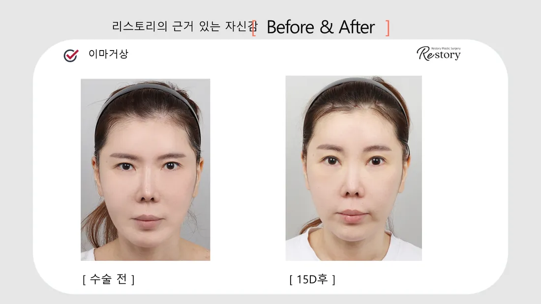 輪郭・額 Before & After — リストーリー整形外科