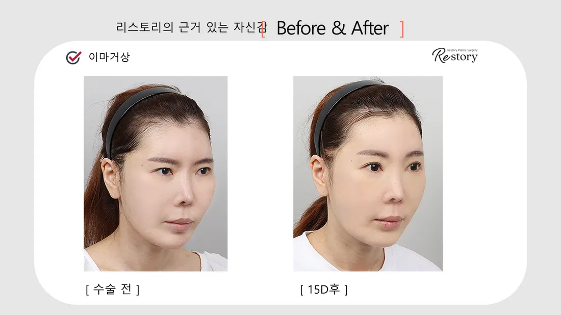 輪郭・額 Before & After — リストーリー整形外科