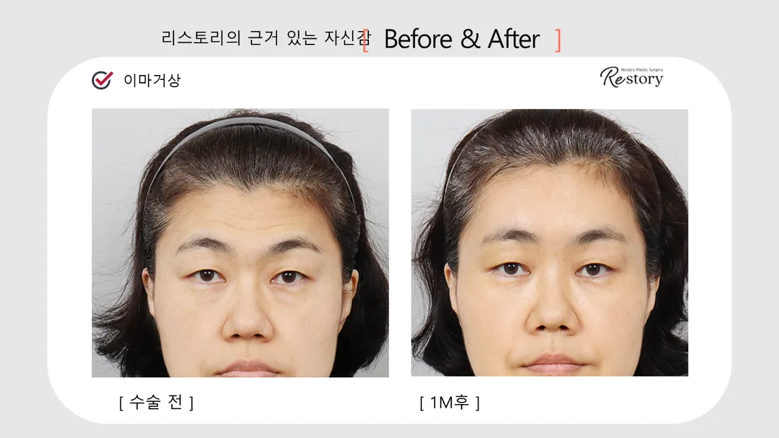 輪郭・額 Before & After — リストーリー整形外科