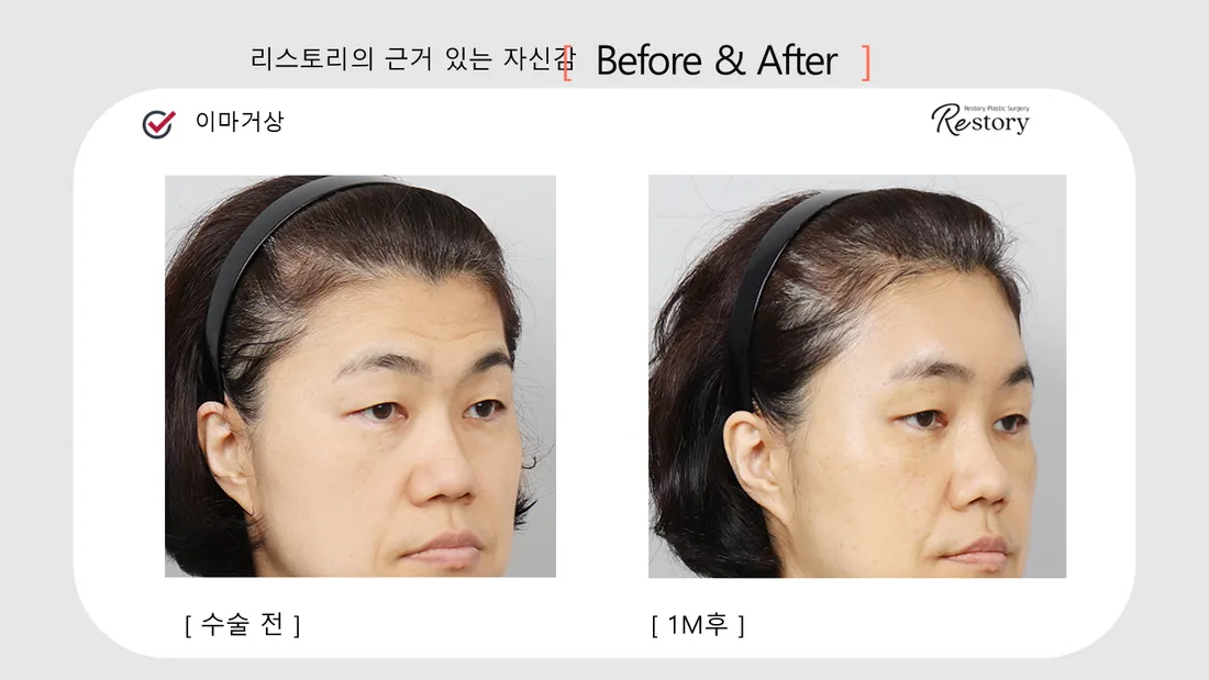 輪郭・額 Before & After — リストーリー整形外科