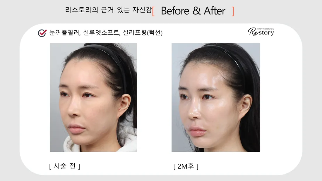 輪郭・額 Before & After — リストーリー整形外科