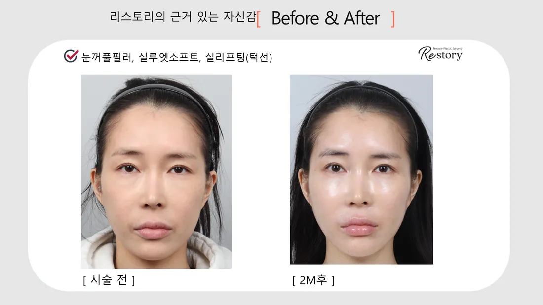 輪郭・額 Before & After — リストーリー整形外科