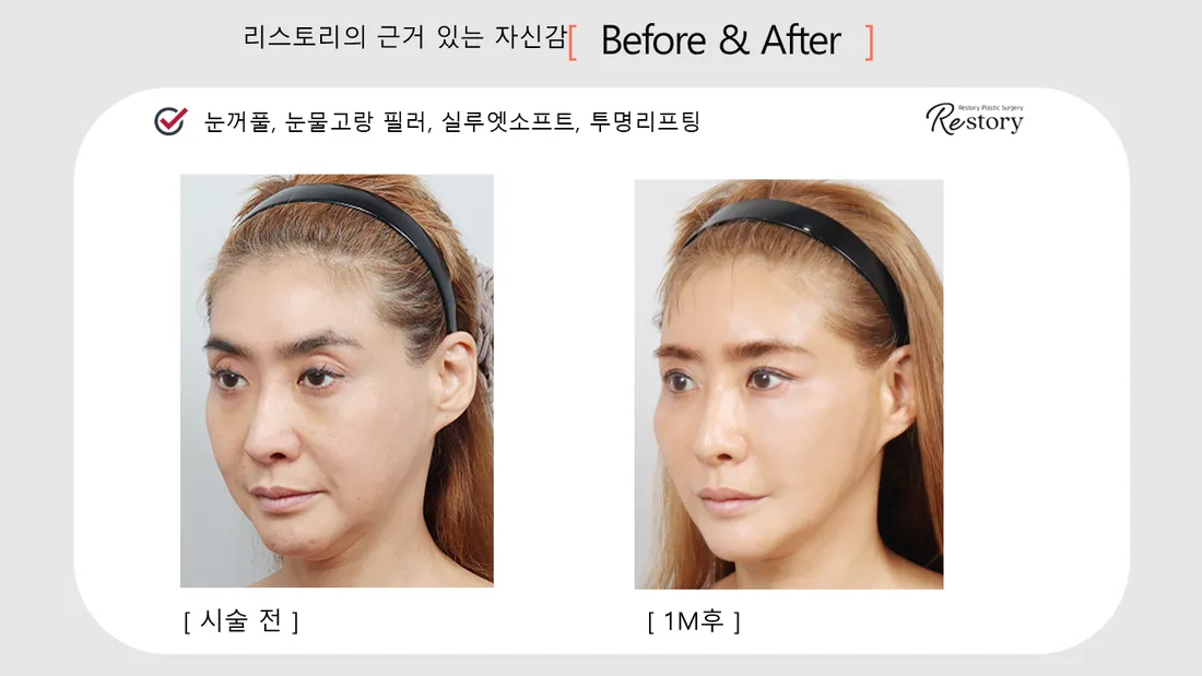 輪郭・額 Before & After — リストーリー整形外科