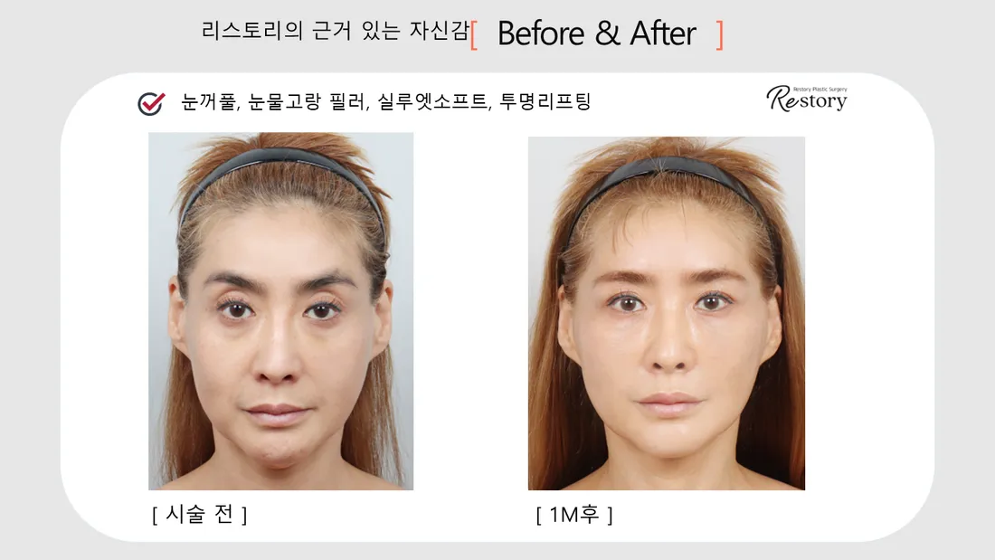 輪郭・額 Before & After — リストーリー整形外科