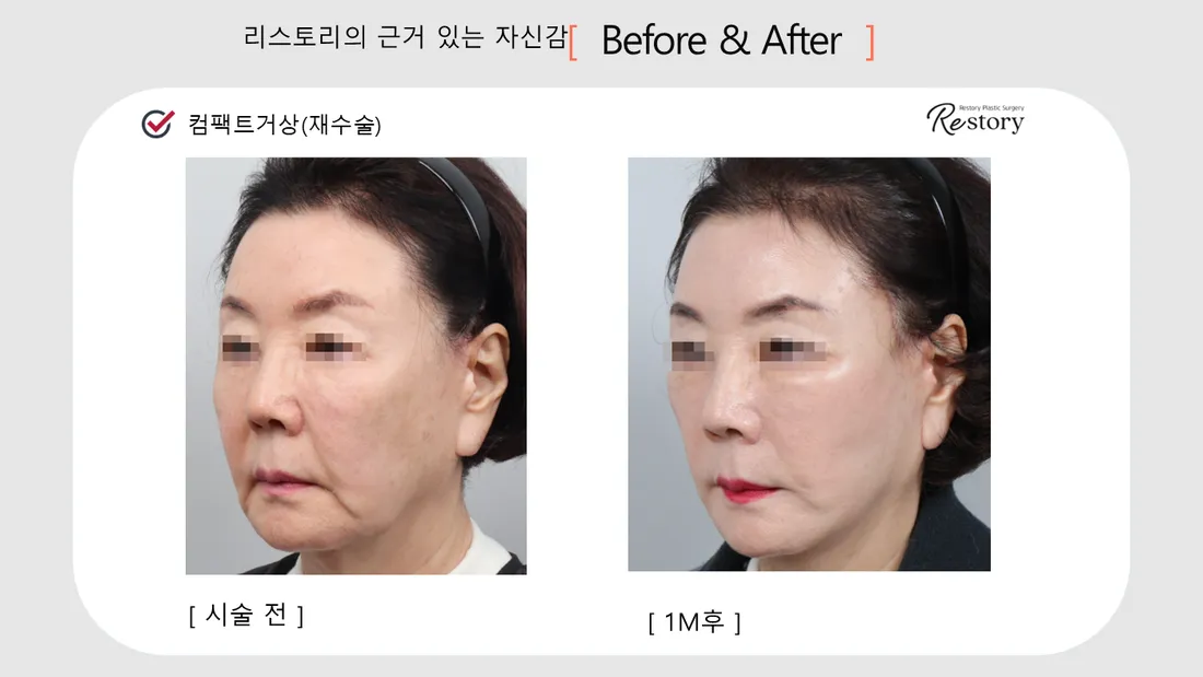 輪郭・額 Before & After — リストーリー整形外科