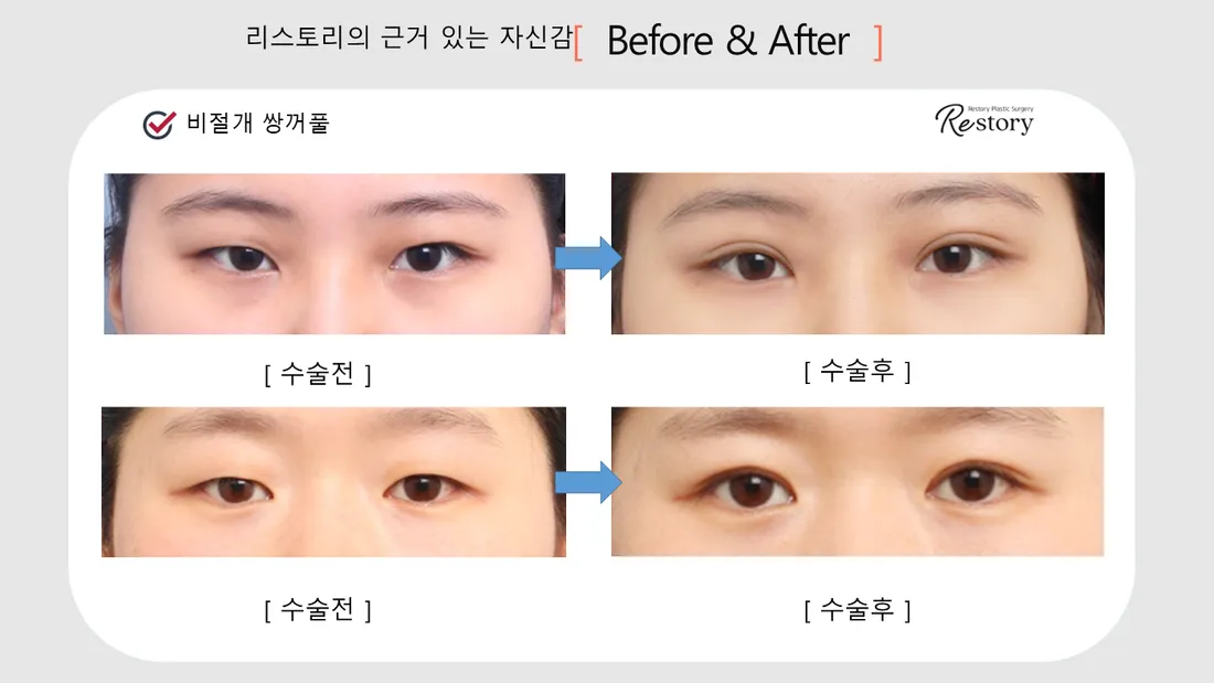 目元 Before & After — リストーリー整形外科