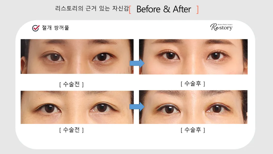 目元 Before & After — リストーリー整形外科