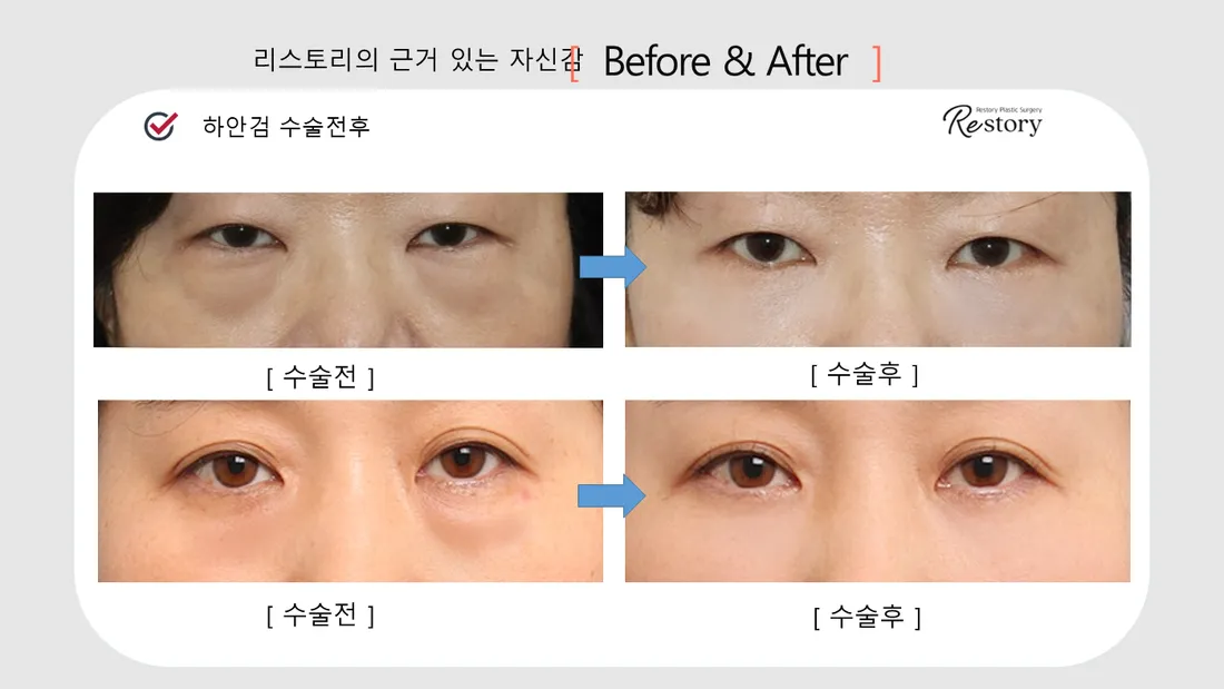 目元 Before & After — リストーリー整形外科