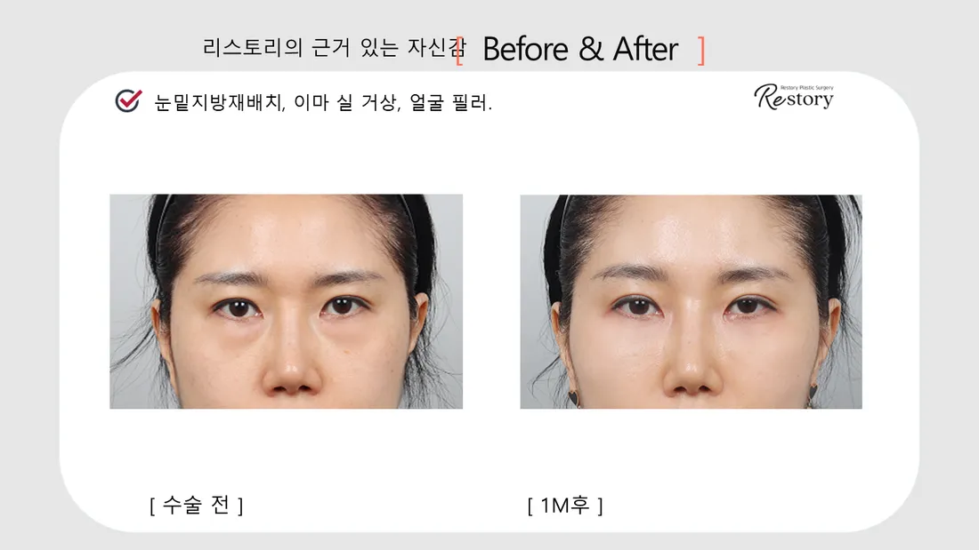 目元 Before & After — リストーリー整形外科
