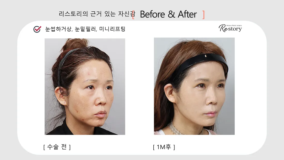 目元 Before & After — リストーリー整形外科