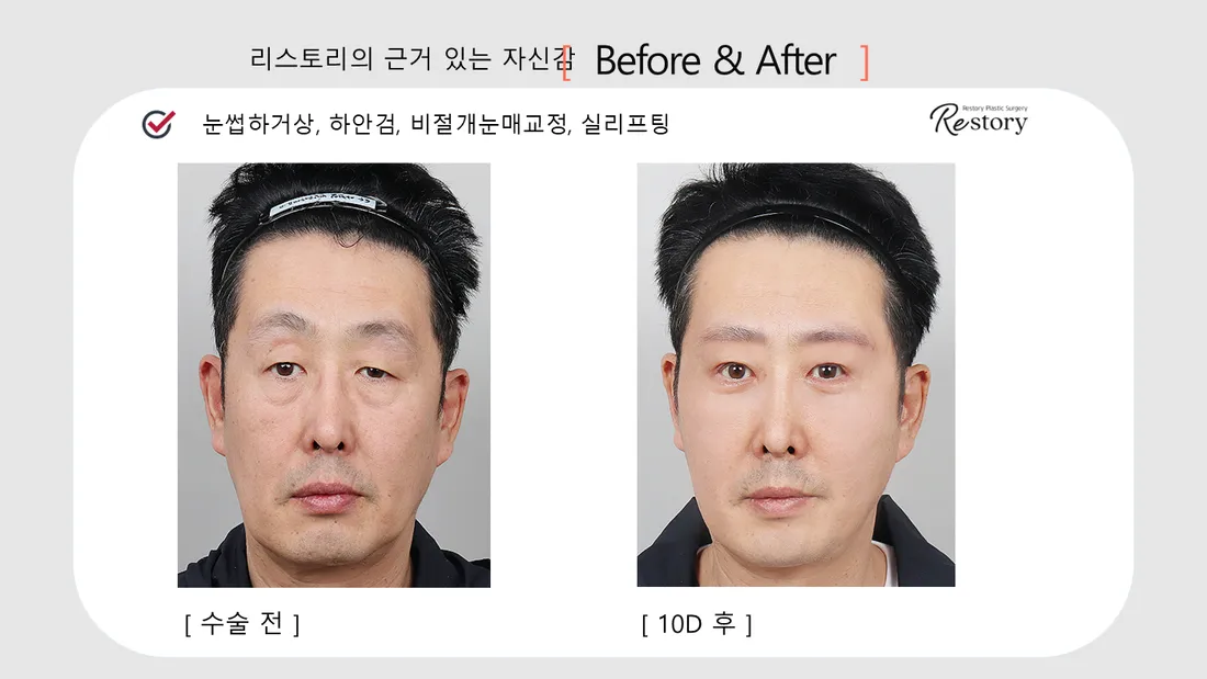 目元 Before & After — リストーリー整形外科