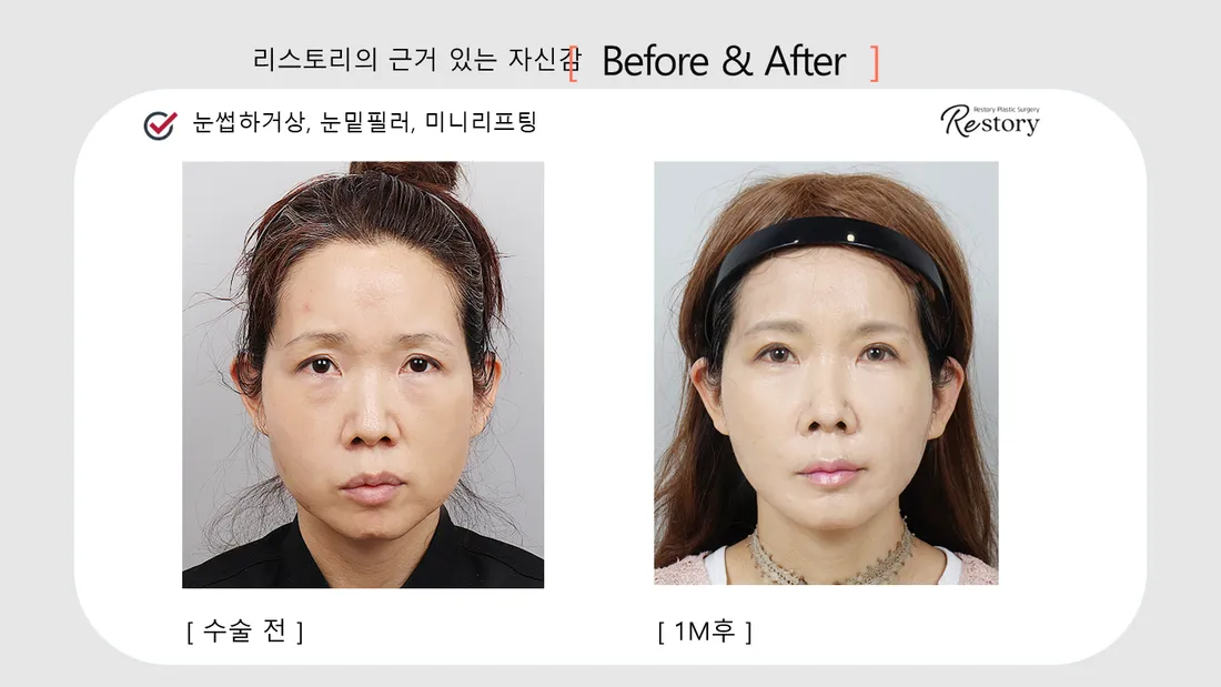 目元 Before & After — リストーリー整形外科
