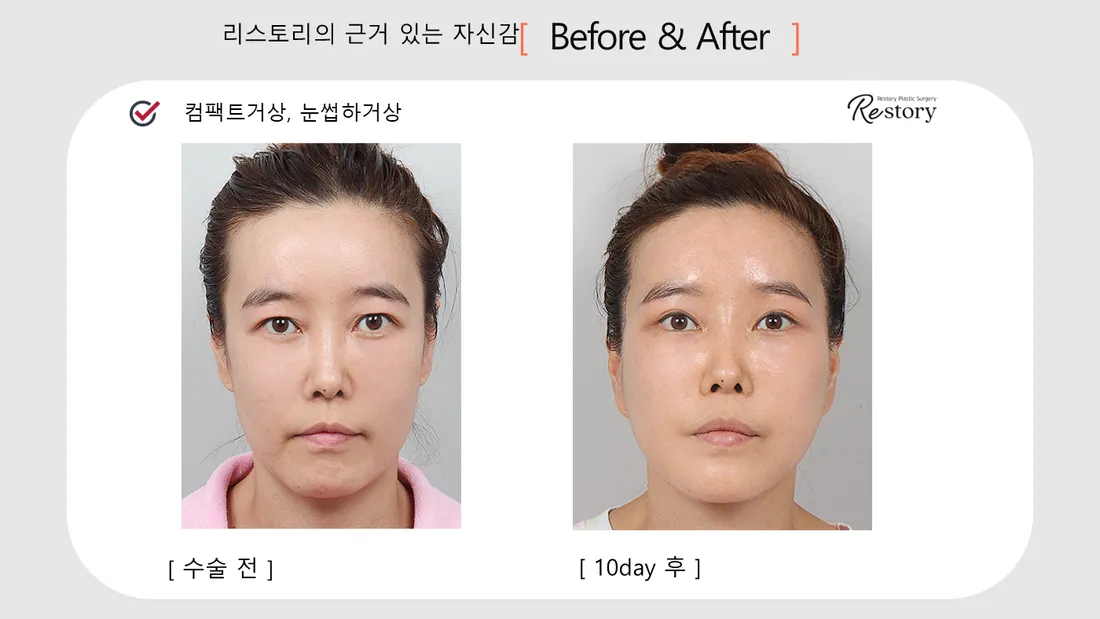 目元 Before & After — リストーリー整形外科