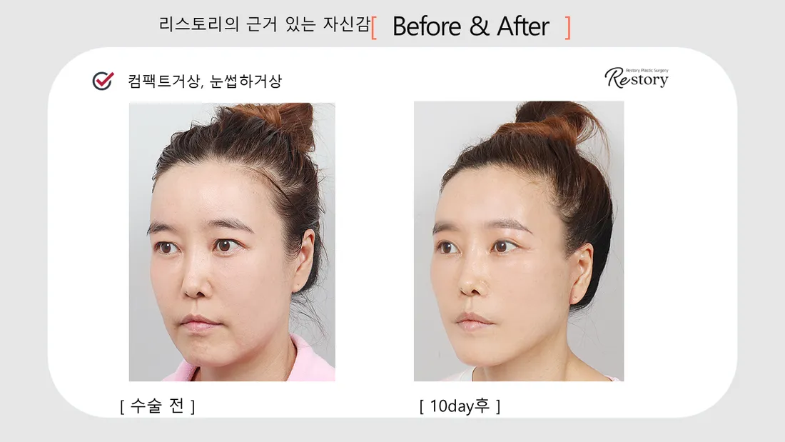 目元 Before & After — リストーリー整形外科