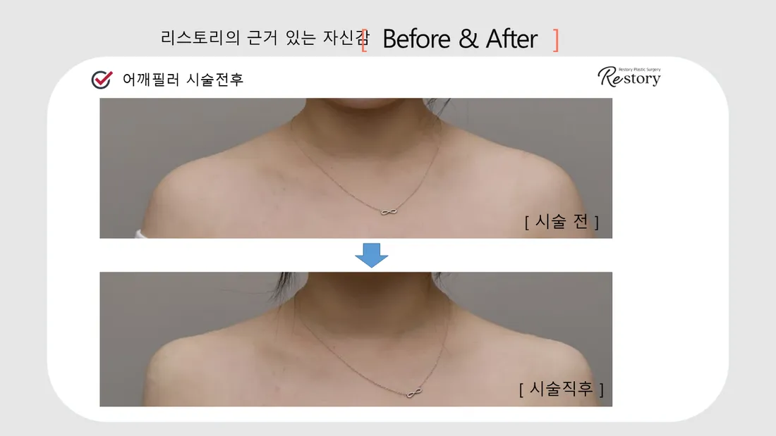首・肩 Before & After — リストーリー整形外科