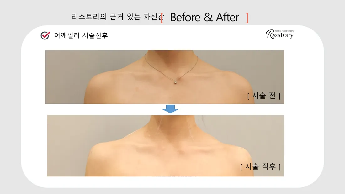 首・肩 Before & After — リストーリー整形外科