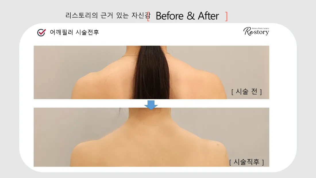 首・肩 Before & After — リストーリー整形外科