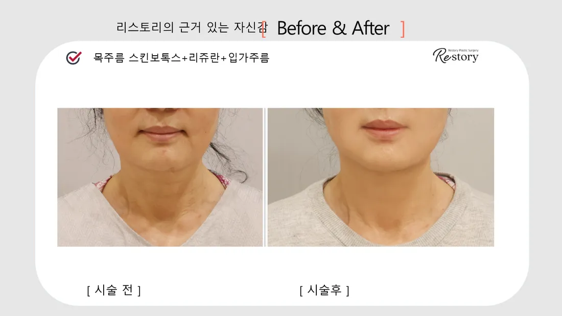 首・肩 Before & After — リストーリー整形外科