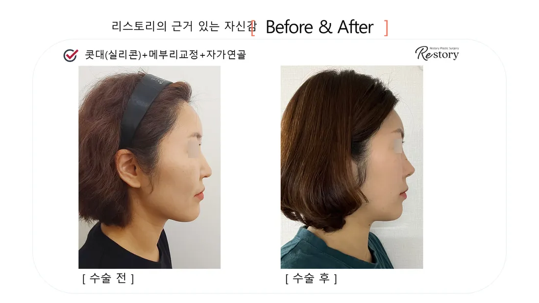 鼻 Before & After — リストーリー整形外科