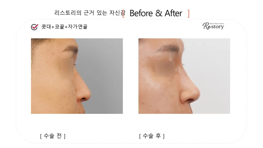 鼻 Before & After — リストーリー整形外科