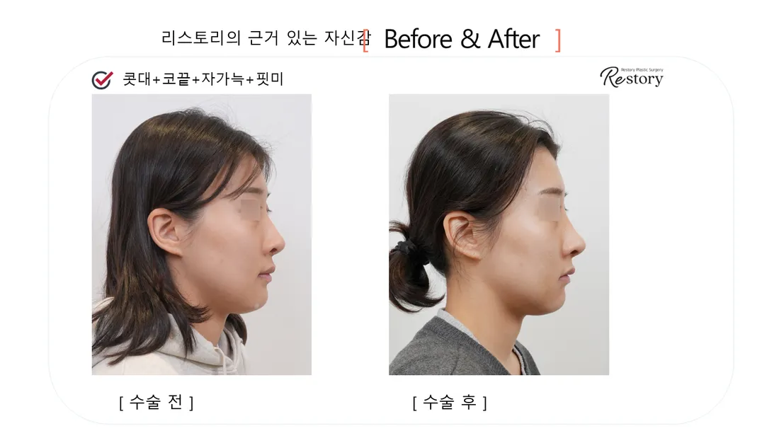 鼻 Before & After — リストーリー整形外科