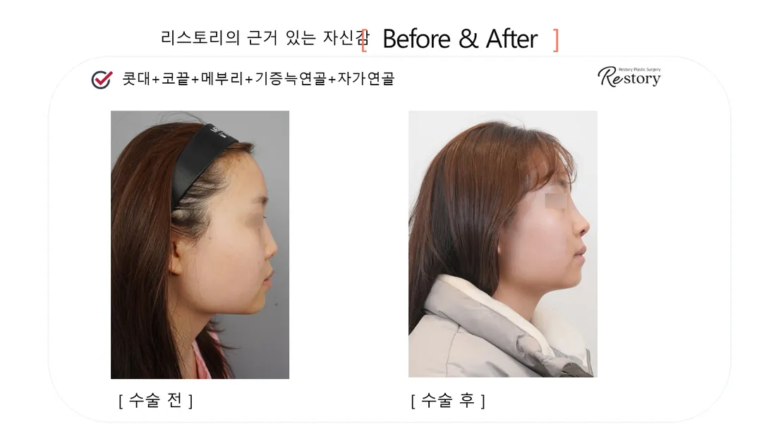 鼻 Before & After — リストーリー整形外科