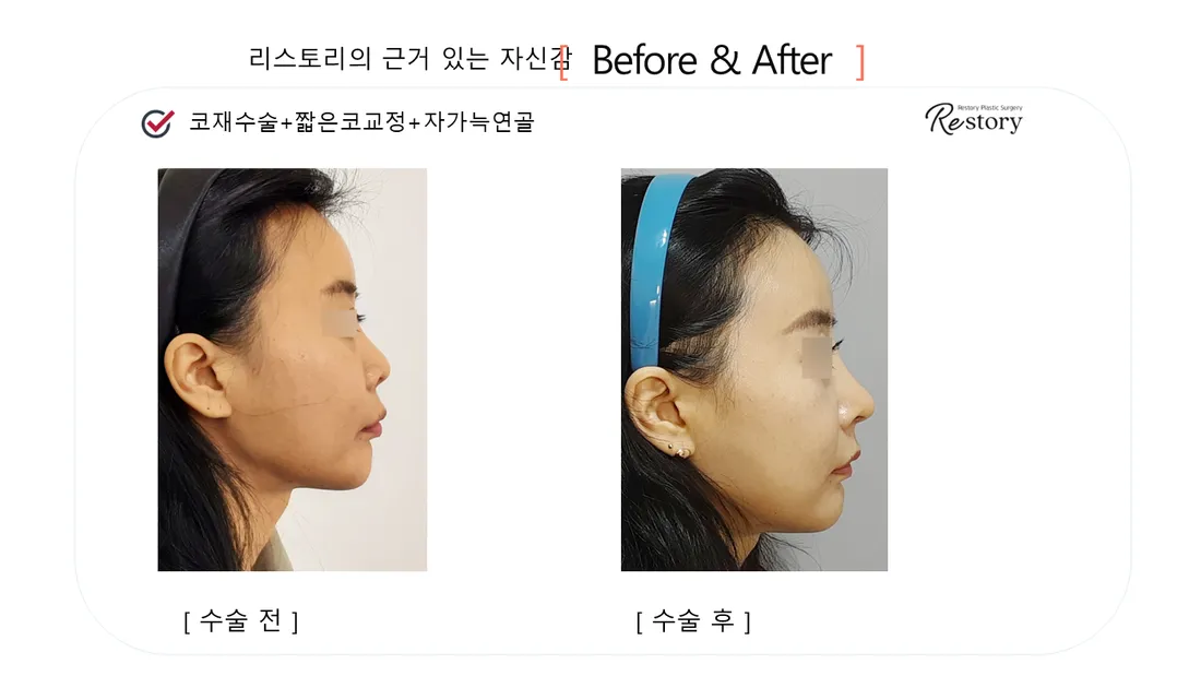鼻 Before & After — リストーリー整形外科