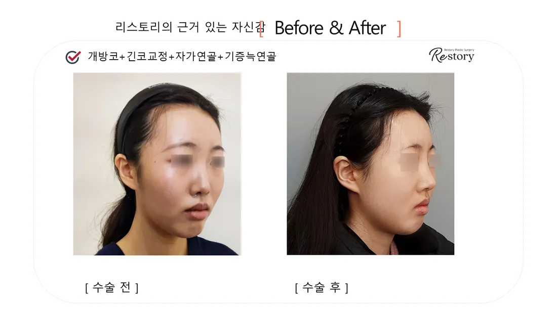鼻 Before & After — リストーリー整形外科