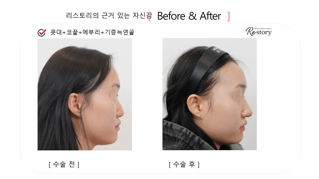 鼻 Before & After — リストーリー整形外科