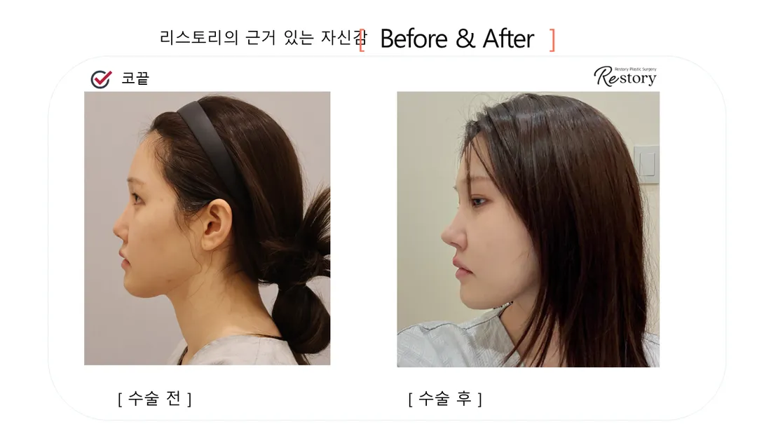 鼻 Before & After — リストーリー整形外科