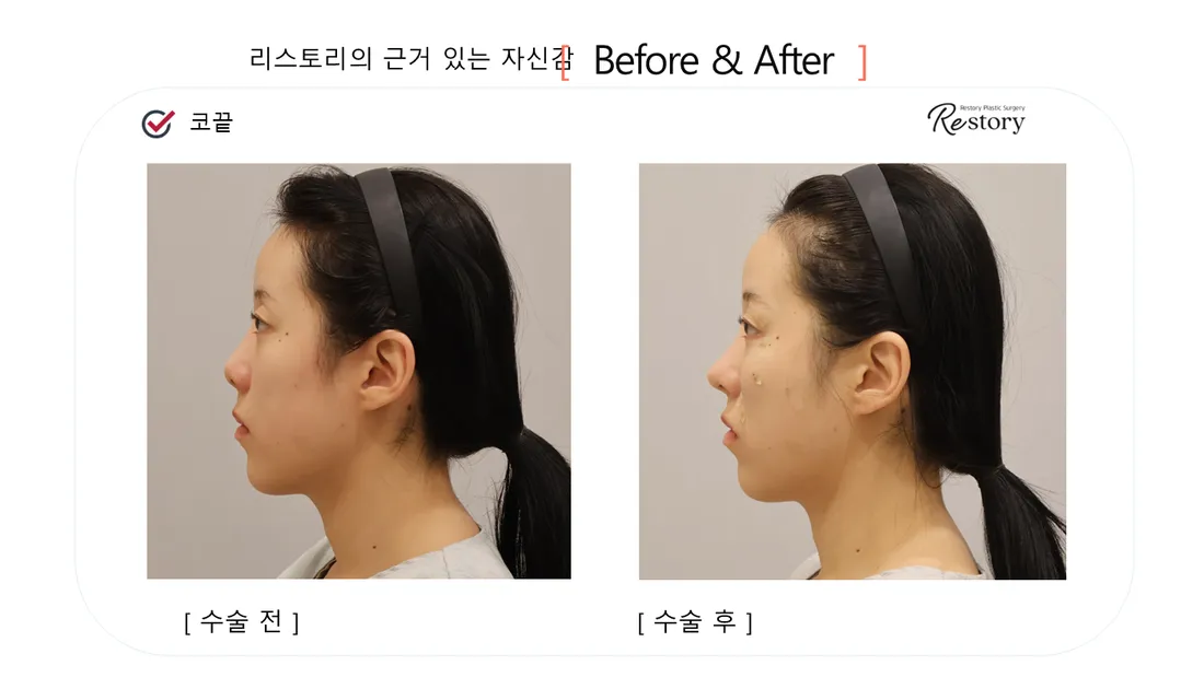 鼻 Before & After — リストーリー整形外科