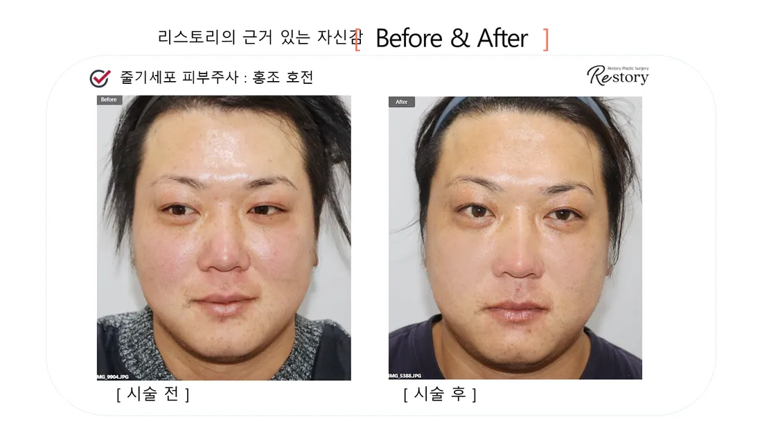 肌・美肌 Before & After — リストーリー整形外科