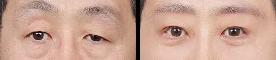 目元 Before & After — リストーリー整形外科