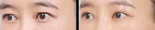 目元 Before & After — リストーリー整形外科