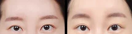 目元 Before & After — リストーリー整形外科