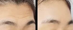 輪郭・額 Before & After — リストーリー整形外科