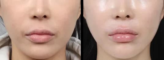 輪郭・額 Before & After — リストーリー整形外科