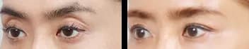 目元 Before & After — リストーリー整形外科