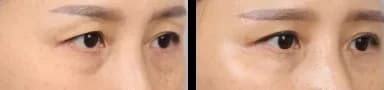 目元 Before & After — リストーリー整形外科