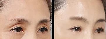 輪郭・額 Before & After — リストーリー整形外科