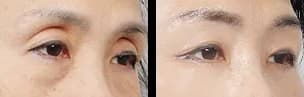 目元 Before & After — リストーリー整形外科