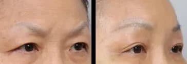 輪郭・額 Before & After — リストーリー整形外科
