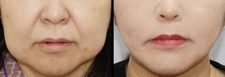 顎・口元・歯科 Before & After — リストーリー整形外科